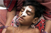Five brain fever cases at Udupi